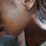 تفشٍ متصاعد للحصبة والسعال الديكي في كبكابية